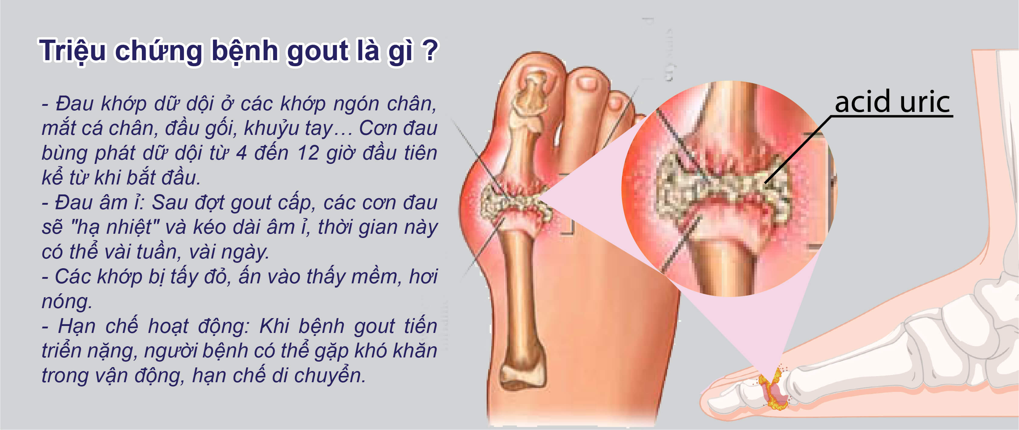 Triệu chứng bệnh gout là gì