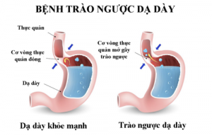 Bệnh trào ngược dạ dày