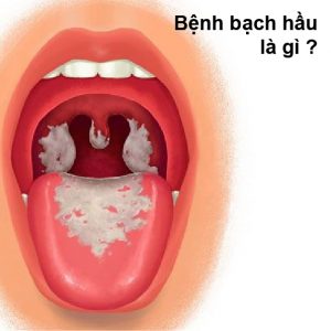 bệnh bạch hầu